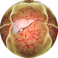 Gan nhiễm mỡ, thừa cân